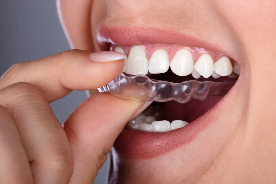 Clear Aligners Inner West